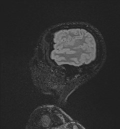 File:Central neurocytoma (Radiopaedia 84497-99872 Sagittal Flair + Gd 131).jpg
