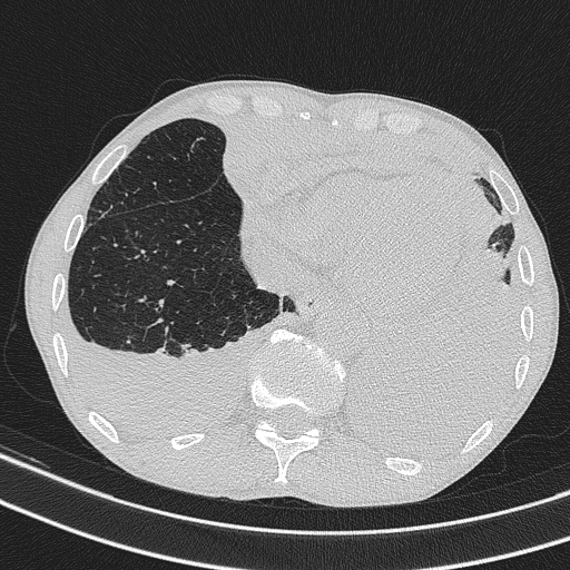 Central venous catheter tip extravasation (Radiopaedia 82828-97113 Axial lung window 67).jpg