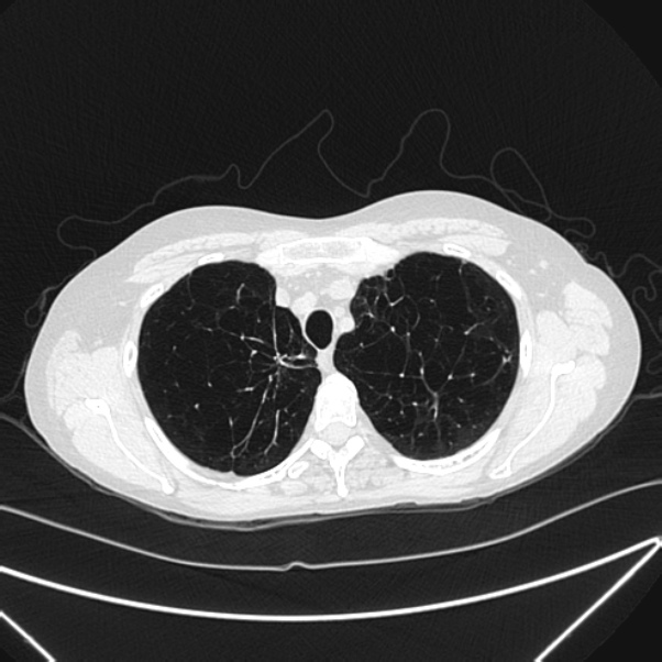 Centrilobular pulmonary emphysema (Radiopaedia 24495-24789 Axial lung window 18).jpg