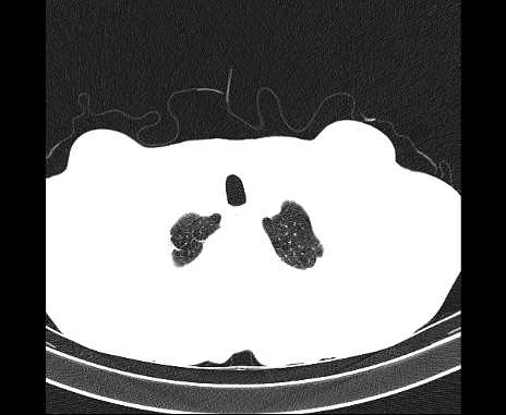 Centrilobular pulmonary emphysema (Radiopaedia 62468-70718 Axial lung window 3).jpg