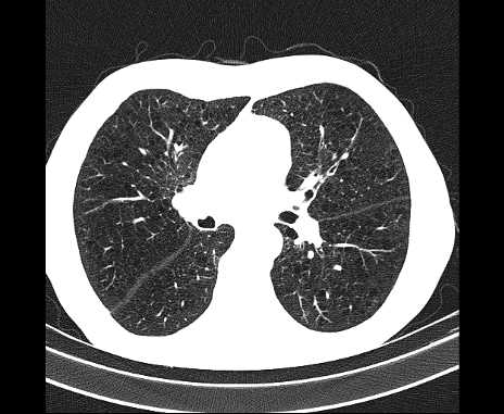 Centrilobular pulmonary emphysema (Radiopaedia 62468-70718 Axial lung window 37).jpg