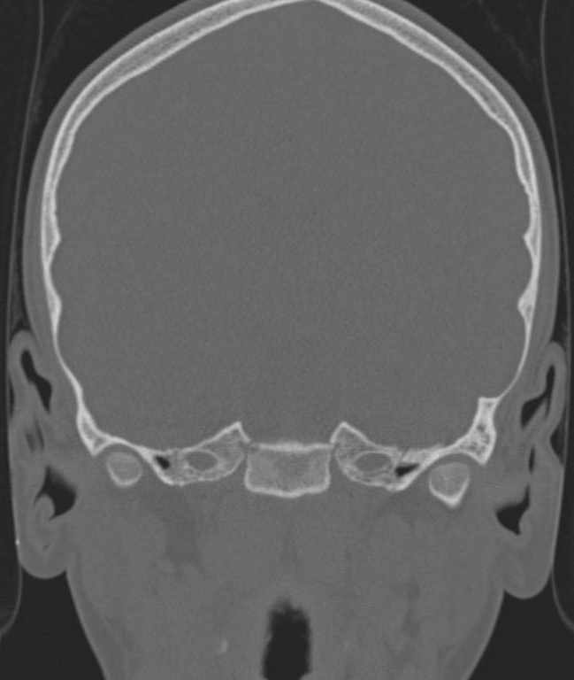 Cerebellar abscess (Radiopaedia 73727-84527 Coronal bone window 85).jpg