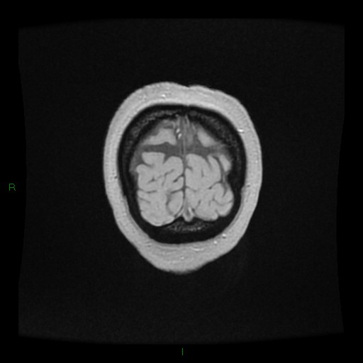 Cerebellar abscess (Radiopaedia 78135-90678 Coronal T1 C+ 163).jpg