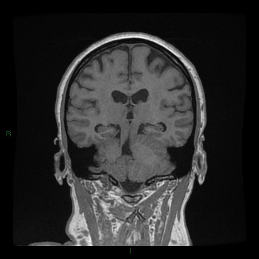 File:Cerebellar abscess (Radiopaedia 78135-90678 Coronal T1 C+ 99).jpg