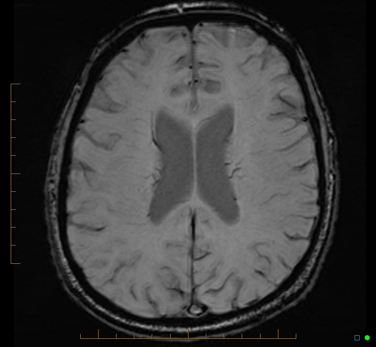 Cerebellar gangliocytoma (Radiopaedia 65377-74422 Axial SWI 37).jpg
