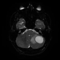 Cerebellar hemangioblastoma (Radiopaedia 29570-30077 Axial DWI 33).jpg
