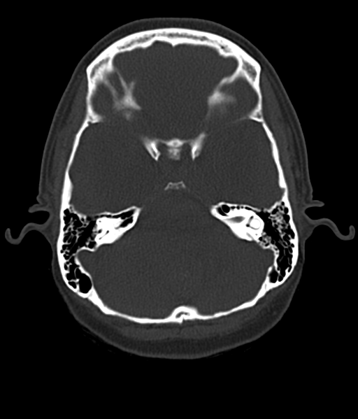 File:Cerebellar metastases - colorectal adenocarcinoma (Radiopaedia 40947-43652 AX Bone C- 2.0 MPR 15).png