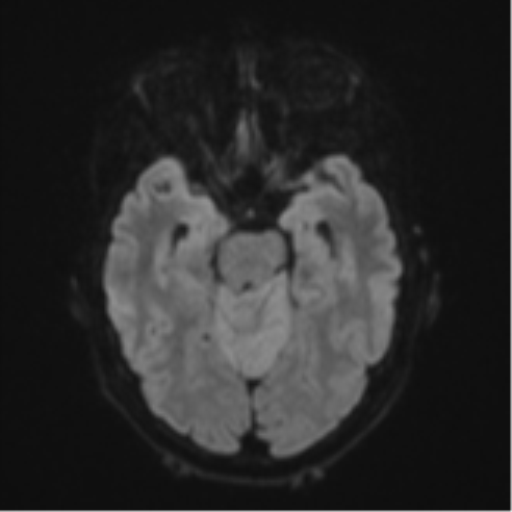Cerebellar metastasis (Radiopaedia 51137-56765 Axial DWI 39).png