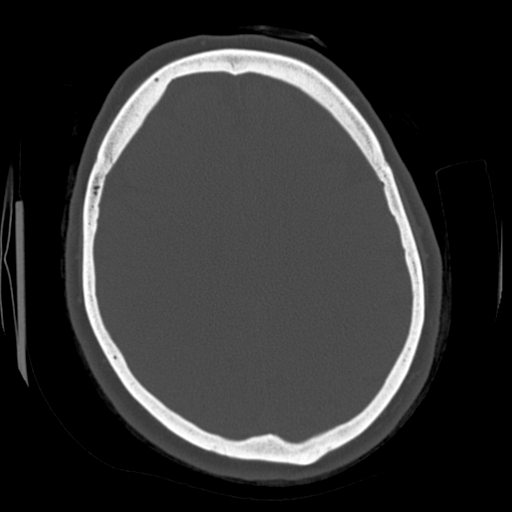 File:Cerebellar metastasis (cystic appearance) (Radiopaedia 41395-44258 Axial bone window 46).png