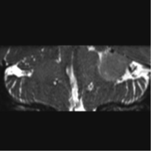 Cerebellopontine angle meningioma (Radiopaedia 48434-53348 Coronal T2 32).png