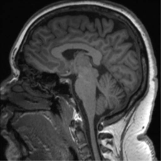 Cerebellopontine angle meningioma (Radiopaedia 48434-53348 Sagittal T1 49).png
