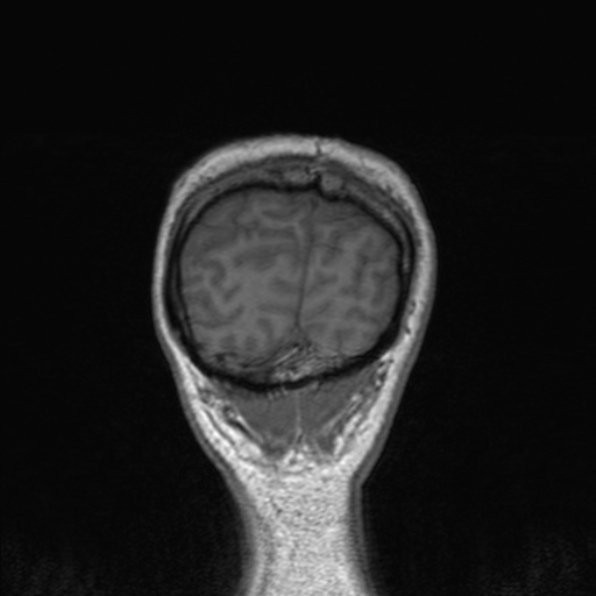 Cerebral abscess (Radiopaedia 24212-24478 Coronal T1 180).jpg