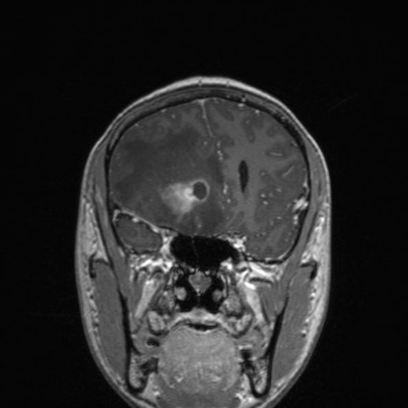 Cerebral abscess (Radiopaedia 24212-24478 Coronal T1 C+ 77).jpg