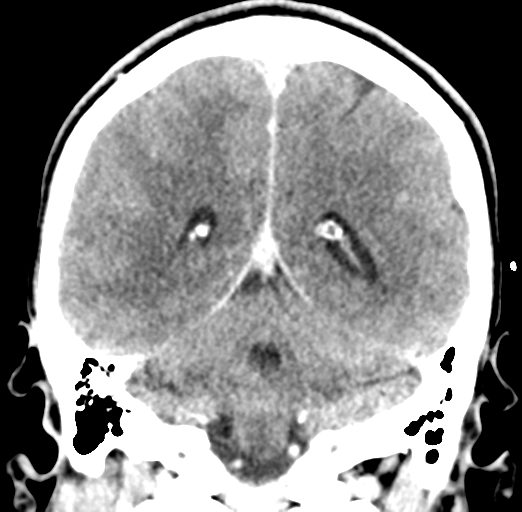 Cerebral abscess (Radiopaedia 60342-68008 Coronal C+ delayed 44).png