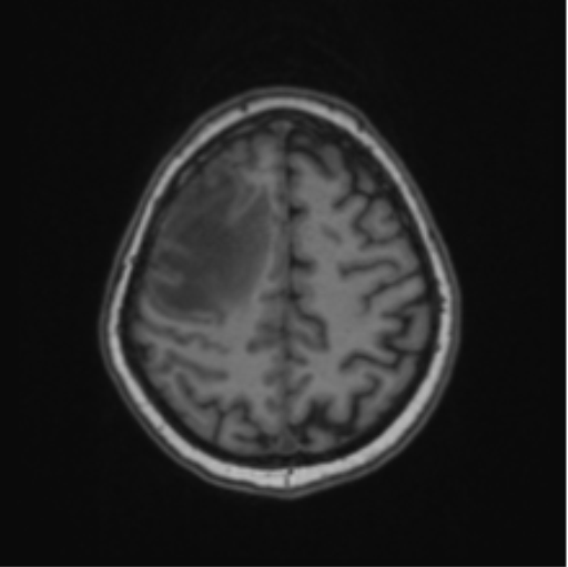 Cerebral abscess from pulmonary arteriovenous malformation (Radiopaedia 86275-102291 Axial T1 58).png