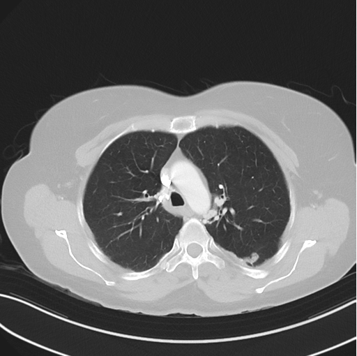 Cerebral abscess from pulmonary arteriovenous malformation (Radiopaedia 86275-102292 Axial lung window 21).png
