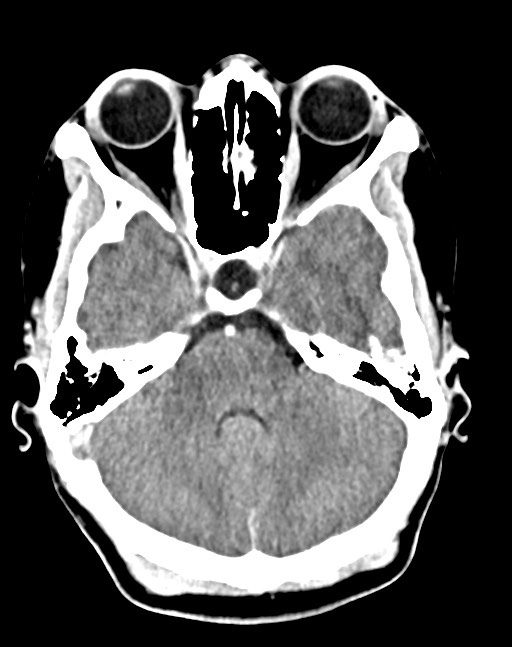 Cerebral abscesses (Radiopaedia 70458-80568 Axial Contrast 20).jpg