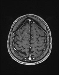 Cerebral amyloid angiopathy-related inflammation (Radiopaedia 58270-65377 Axial T1 C+ fat sat 121).jpg