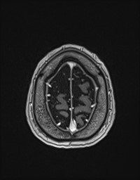 Cerebral amyloid angiopathy-related inflammation (Radiopaedia 58270-65377 Axial T1 C+ fat sat 137).jpg