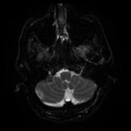 File:Cerebral amyloid angiopathy (Radiopaedia 28698-28978 Axial DWI 32).jpg