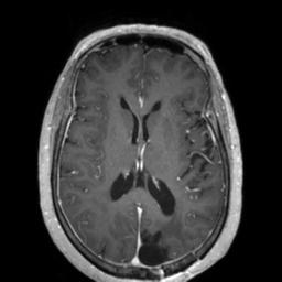 Cerebral amyloid angiopathy (Radiopaedia 29129-29518 Axial T1 C+ 84).jpg