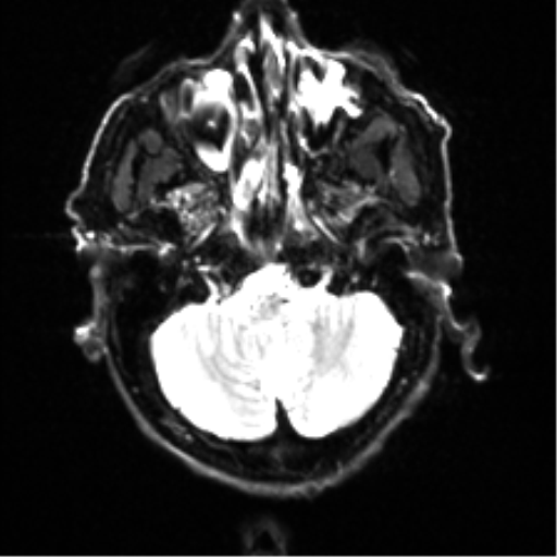 File:Cerebral amyloid angiopathy (Radiopaedia 46082-50433 Axial DWI 4).png