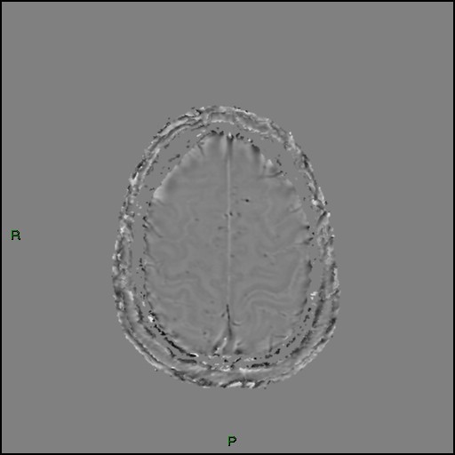 File:Cerebral amyloid angiopathy (Radiopaedia 77506-89664 H 87).jpg