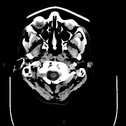 Cerebral amyloid angiopathy (Radiopaedia 77506-89665 Axial non-contrast 4).jpg