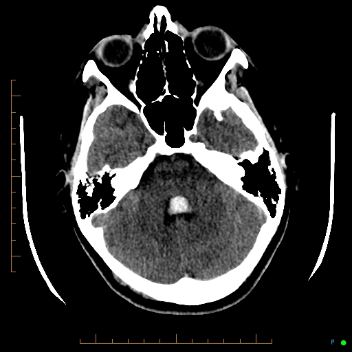 File:Cerebral arteriovenous malformation (AVM) (Radiopaedia 78162-90706 Axial non-contrast 19).jpg