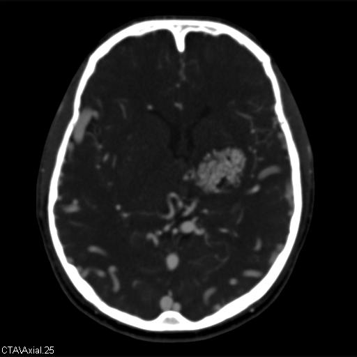 Cerebral arteriovenous malformation (Radiopaedia 28518-28759 B 25).jpg
