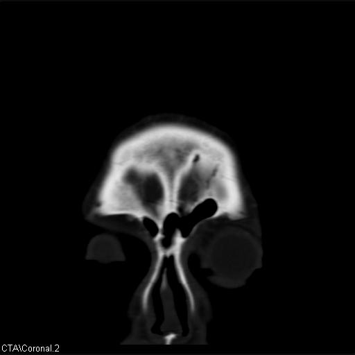 Cerebral arteriovenous malformation (Radiopaedia 28518-28759 C 2).jpg