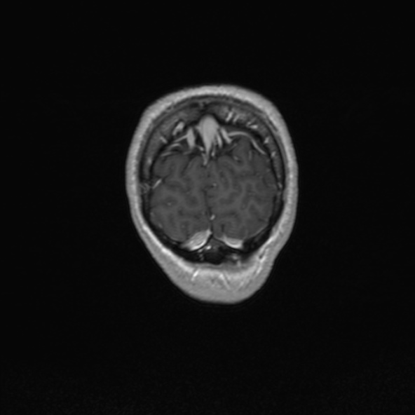 Cerebral arteriovenous malformation (Radiopaedia 30198-30813 F 54).jpg