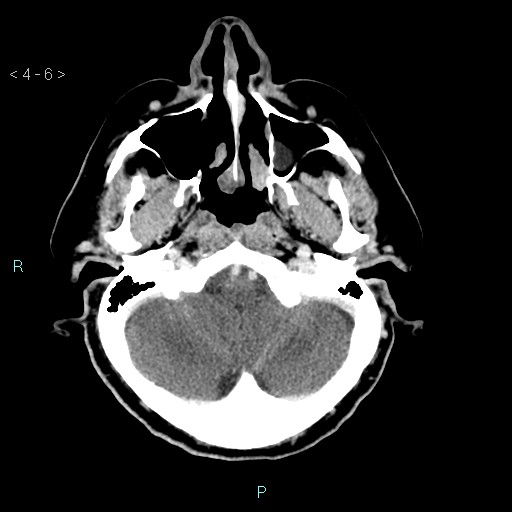 File:Cerebral arteriovenous malformation (Radiopaedia 40528-43125 Axial C+ delayed 6).jpg