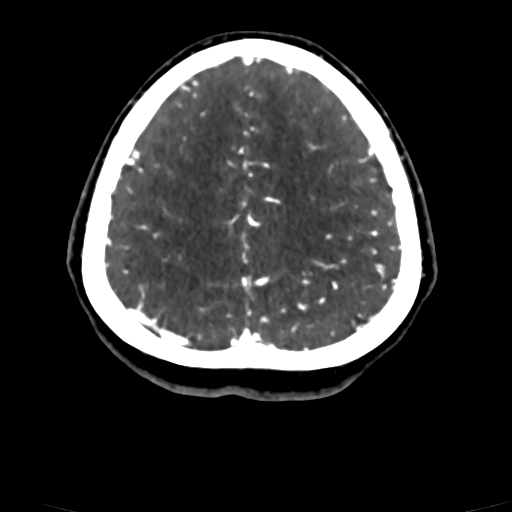 Cerebral arteriovenous malformation (Radiopaedia 73830-84645 Axial C+ delayed 18).jpg