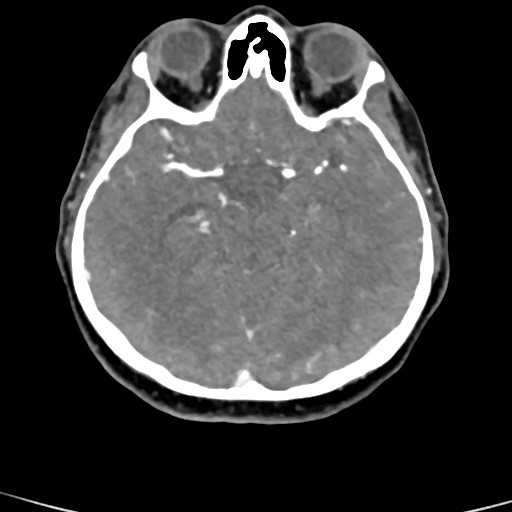 Cerebral arteriovenous malformation (Radiopaedia 73830-84645 B 60).jpg