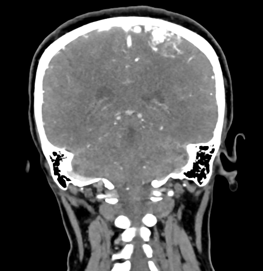 File:Cerebral arteriovenous malformation (Radiopaedia 73830-84645 C 66).jpg
