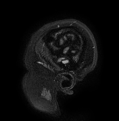 Cerebral arteriovenous malformation (Radiopaedia 74411-85654 Sagittal FLAIR 4).jpg