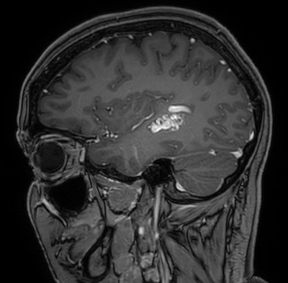Cerebral arteriovenous malformation (Radiopaedia 74411-85654 Sagittal T1 C+ 33).jpg
