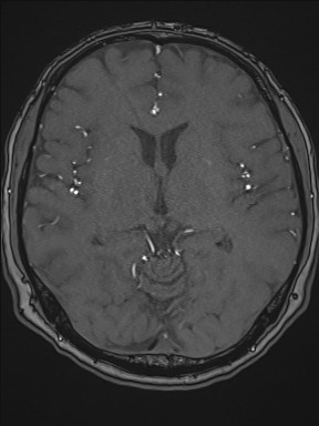 File:Cerebral arteriovenous malformation (Radiopaedia 84015-99245 Axial TOF 126).jpg