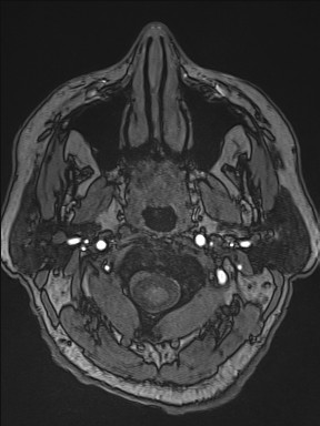 Cerebral arteriovenous malformation (Radiopaedia 84015-99245 Axial TOF 14).jpg