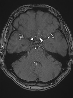 File:Cerebral arteriovenous malformation (Radiopaedia 84015-99245 Axial TOF 89).jpg