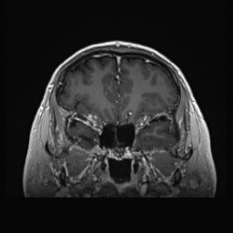 Cerebral arteriovenous malformation (Radiopaedia 84015-99245 Coronal T1 C+ 46).jpg