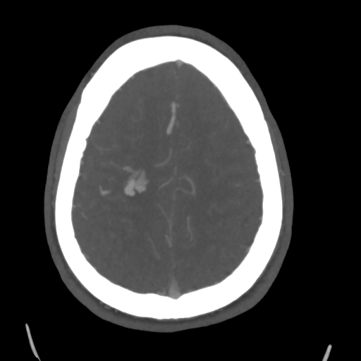 Cerebral arteriovenous malformation (Spetzler-Martin grade 2) (Radiopaedia 41262-44076 E 42).png