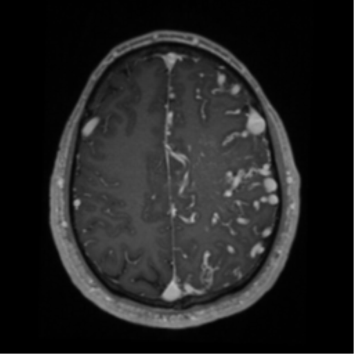 File:Cerebral arteriovenous malformation - huge (Radiopaedia 35734-37272 Axial T1 C+ 55).png