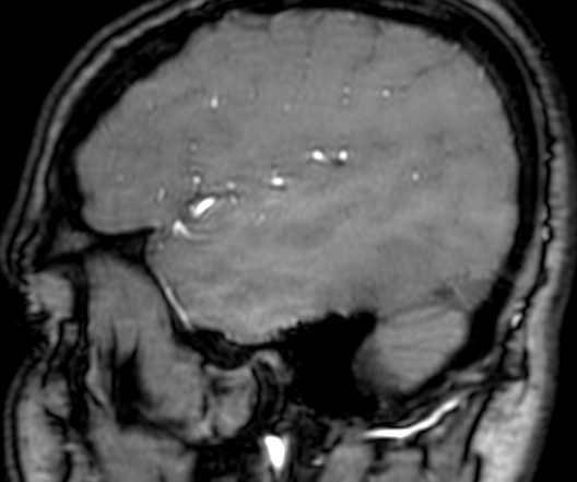 Cerebral arteriovenous malformation at posterior body of corpus callosum (Radiopaedia 74111-84925 J 338).jpg