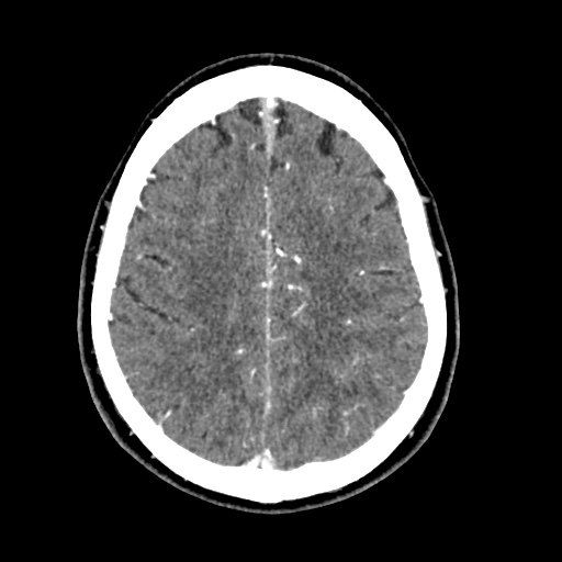 Cerebral arteriovenous malformation with lobar hemorrhage (Radiopaedia 35598-57216 A 46).jpg