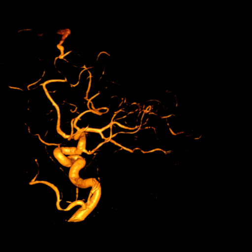 Cerebral arteriovenous malformation with lobar hemorrhage (Radiopaedia 44725-48513 Lateral 17).png