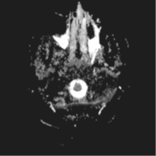 File:Cerebral cavernoma and development venous anomaly (Radiopaedia 37603-39482 Axial ADC 2).png