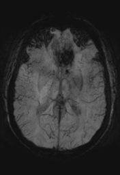 File:Cerebral cavernoma and development venous anomaly (Radiopaedia 37603-39482 Axial SWI MIP 18).png