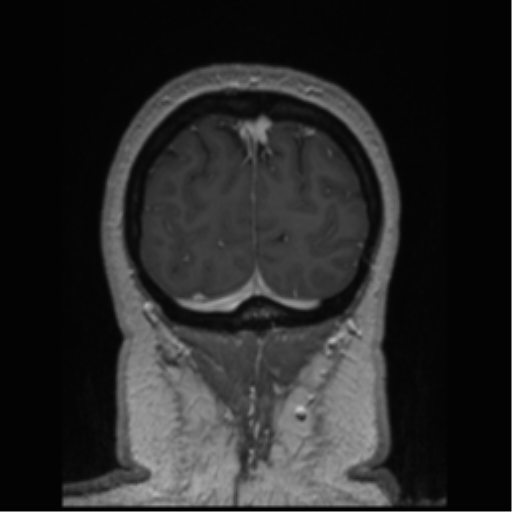Cerebral cavernoma and development venous anomaly (Radiopaedia 37603-39482 Coronal T1 C+ 13).png
